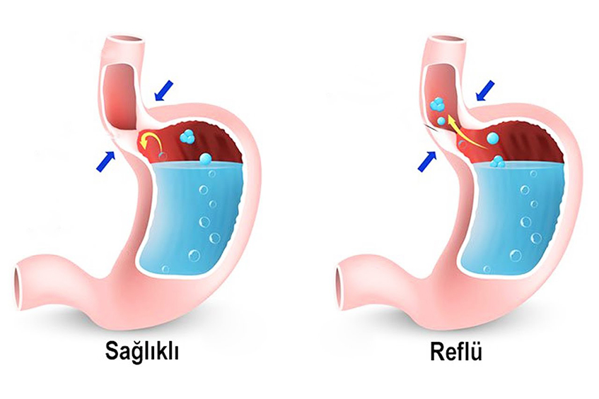 Çocuklarda Gastroözefajial Reflü